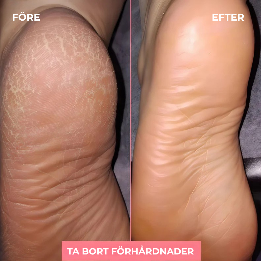 Elektrisk förhårdnadsfotslip – mjuka fötter hemma